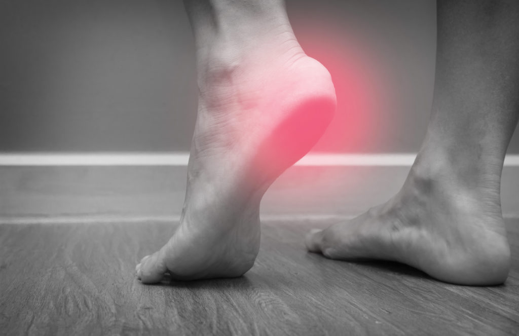 Plantar Fasciitis